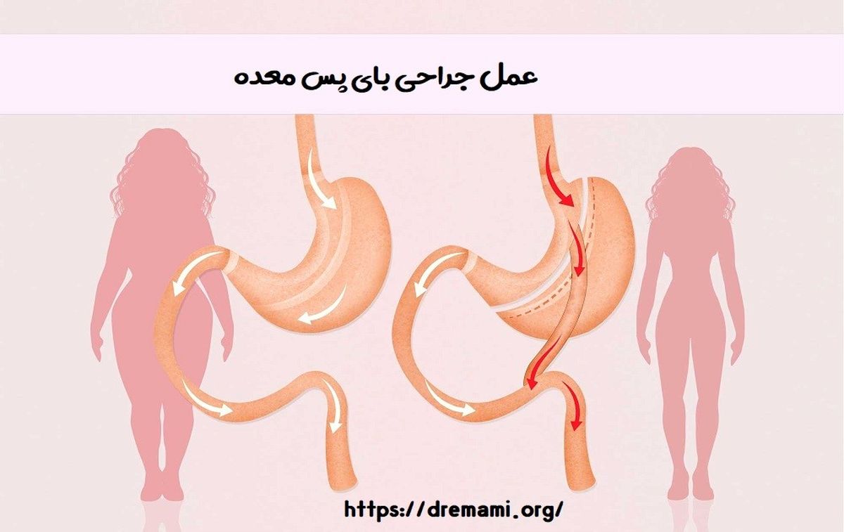 آشنایی با جنبه های مثبت و منفی عمل جراحی بای پس معده