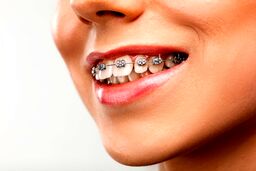 مشکلات بعد از ارتودنسی