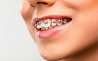 مشکلات بعد از ارتودنسی