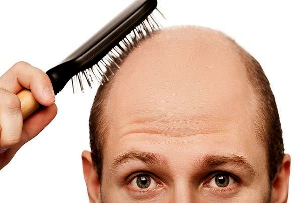 نصف جمعیت ایران مشکل ریزش موی سر دارند