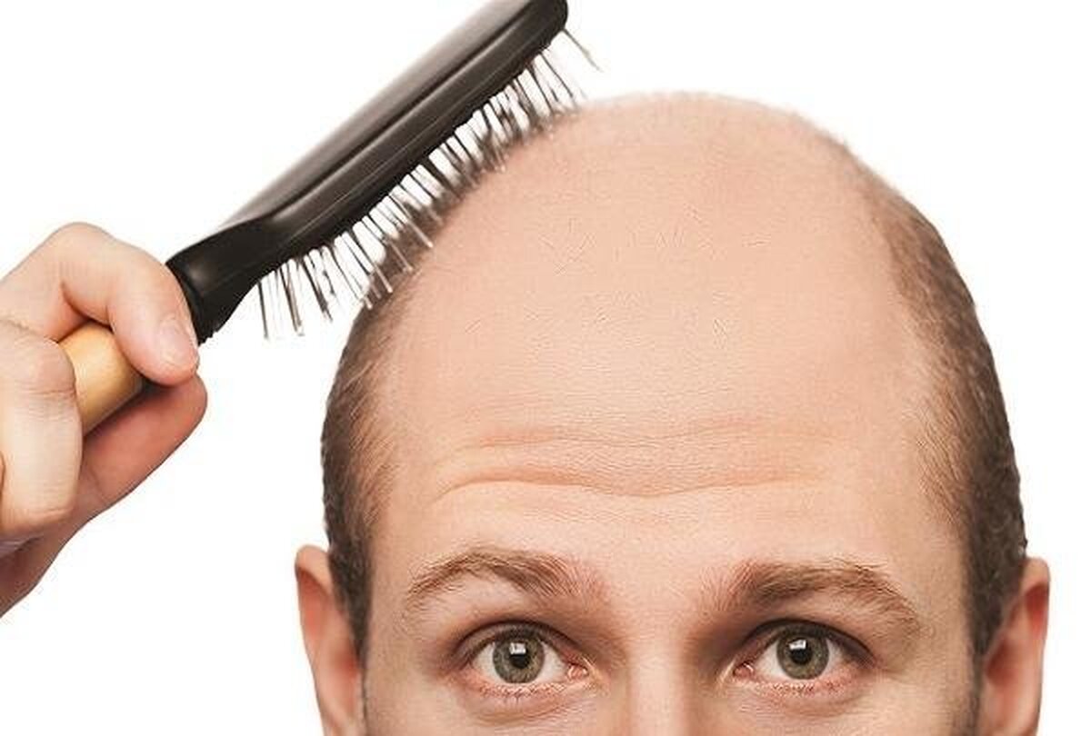 نصف جمعیت ایران مشکل ریزش موی سر دارند