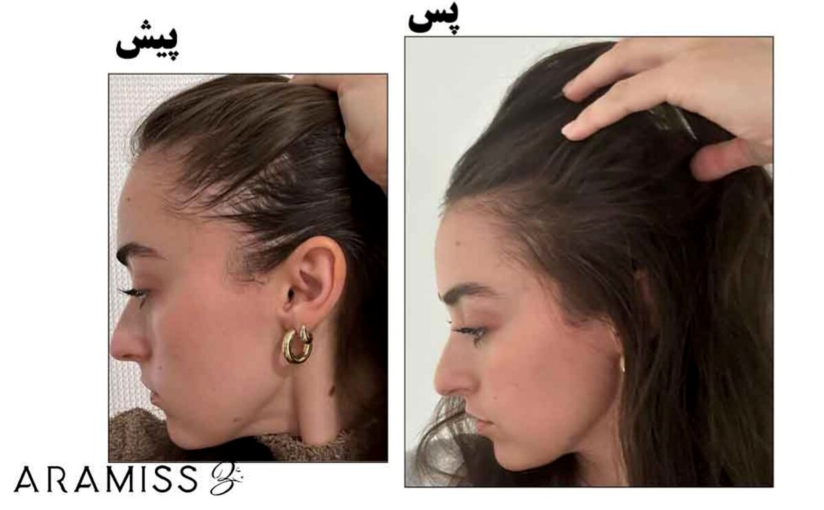 درمان ریزش مو سریع و خانگی 