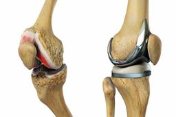 همه چیز در مورد تعویض مفصل زانو