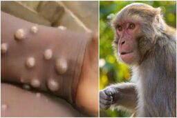 هشدار وزارت بهداشت | آبله میمون بیخ گوش ایران