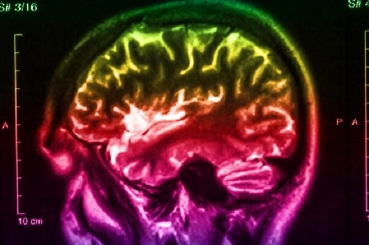 فناوری جدید تصویربرداری فورا پارکینسون را تشخیص می دهد