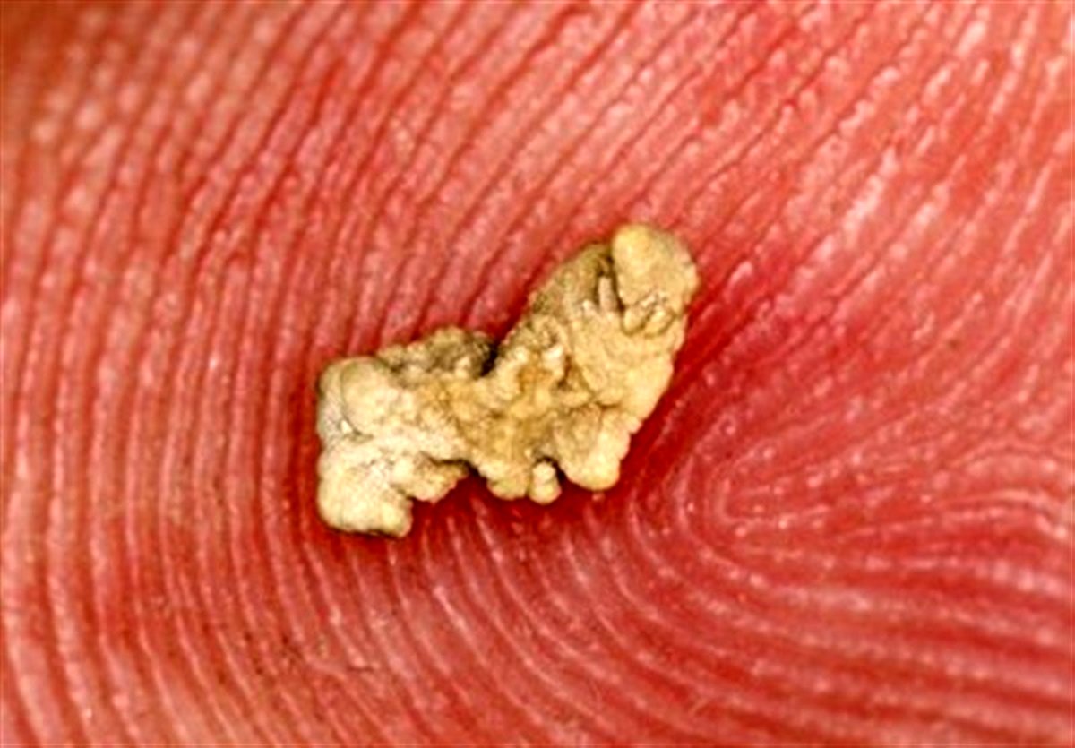 روش های ساده یرای رهایی ار سنگ کلیه