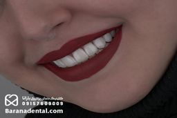 ارائه خدمات دندانپزشکی مشهد به صورت اقساطی و چکی در کلینیک بارانا