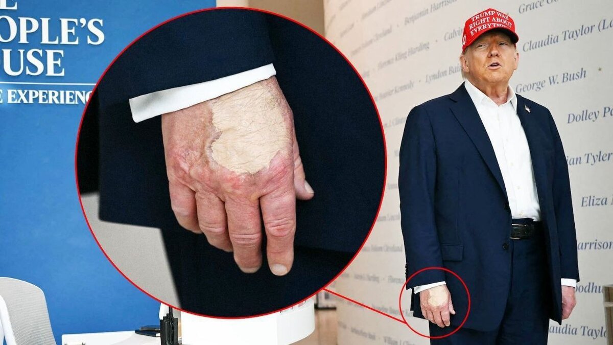 کبودی روی دست راست ترامپ دوباره جنجالی شد + عکس جدید