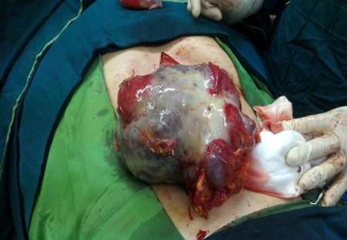 تومور 4.5 کیلویی از شکم بیمار62ساله