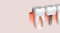 قیمت ایمپلنت در ایران (سال 1401)