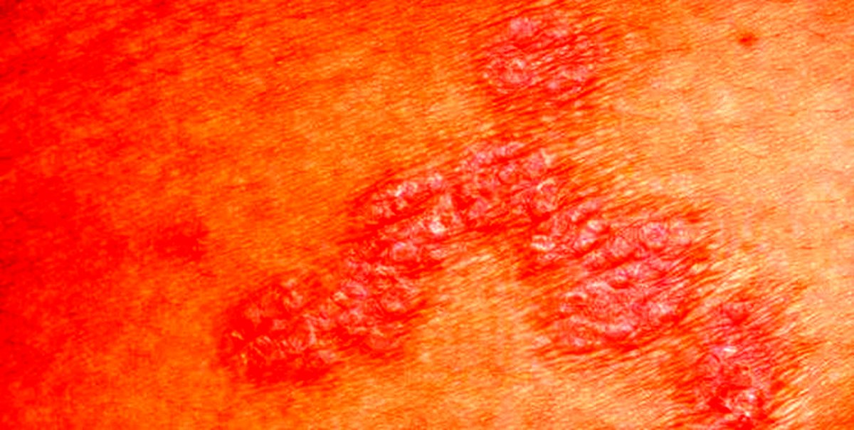 آلودگی هوا چه آسیبی به «پوست» میزند؟