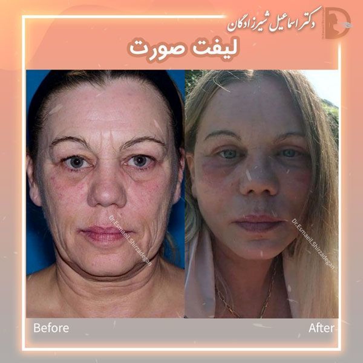 قیمت لیفت صورت توسط دکتر شیرزادگان