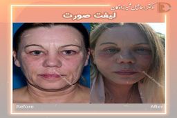 قیمت لیفت صورت توسط دکتر شیرزادگان