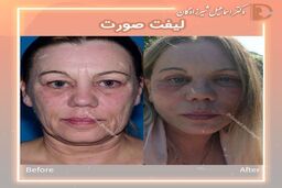 قیمت لیفت صورت توسط دکتر شیرزادگان