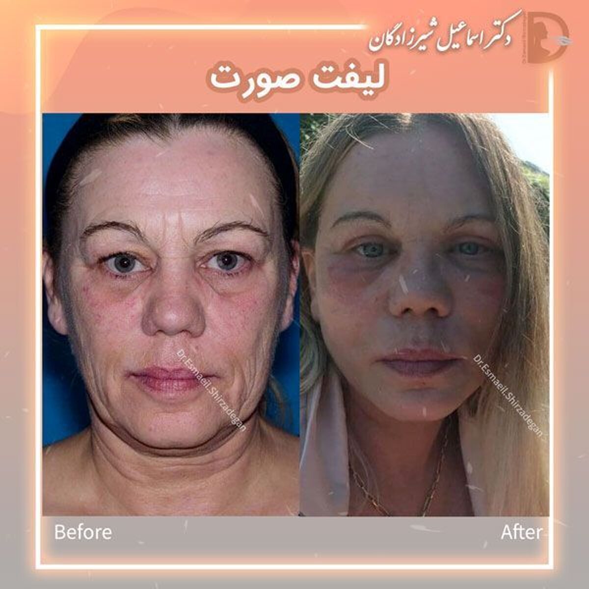 قیمت لیفت صورت توسط دکتر شیرزادگان