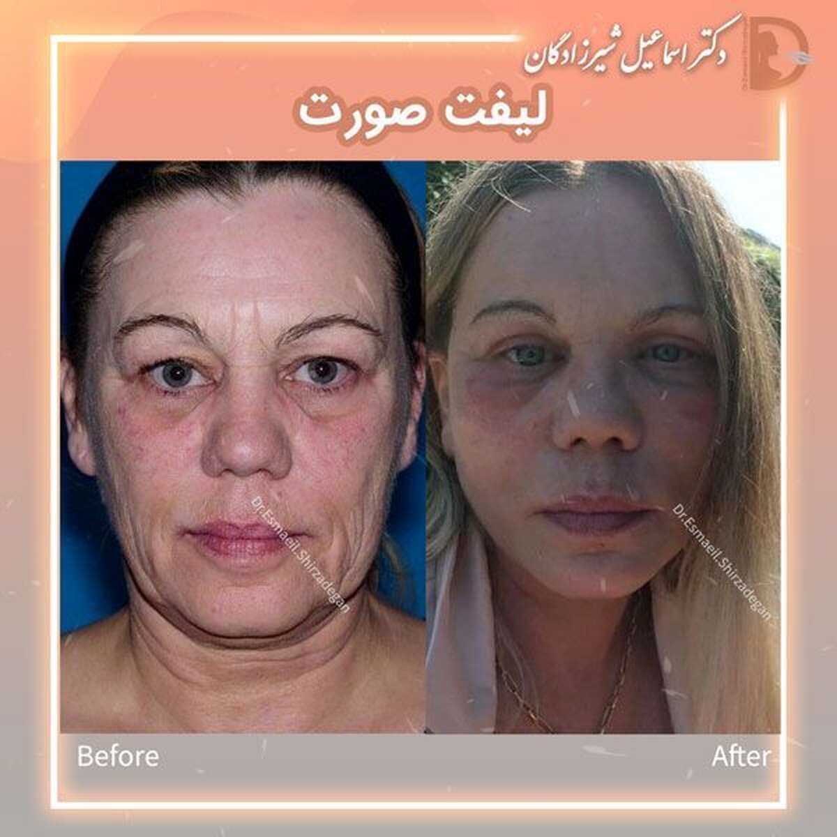 قیمت لیفت صورت توسط دکتر شیرزادگان