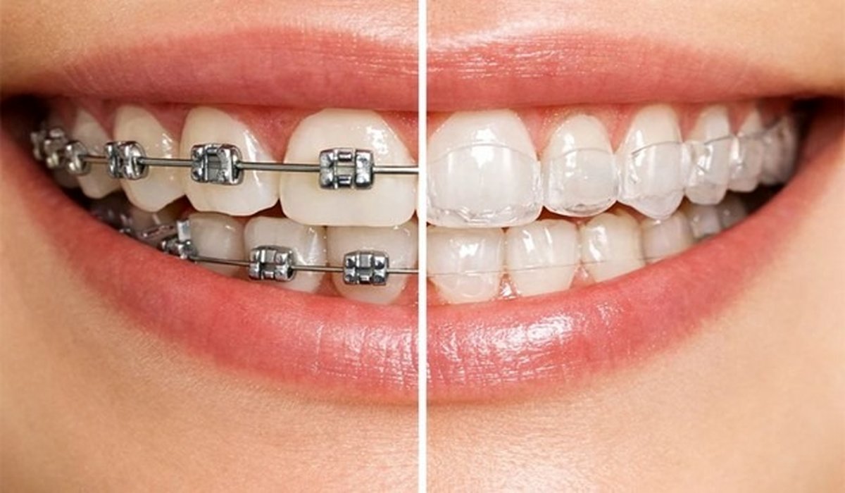 ارتودنسی دندان روکش‌شده از نظر دندانپزشک؛ سیمی بهتر است یا شفاف؟ 