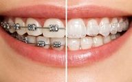 ارتودنسی دندان روکش‌شده از نظر دندانپزشک؛ سیمی بهتر است یا شفاف؟ 