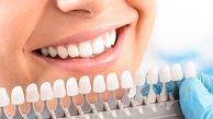 تفاوت لمینت دندان و ونیر کامپوزیت از نظر قیمت و ماندگاری چیست؟