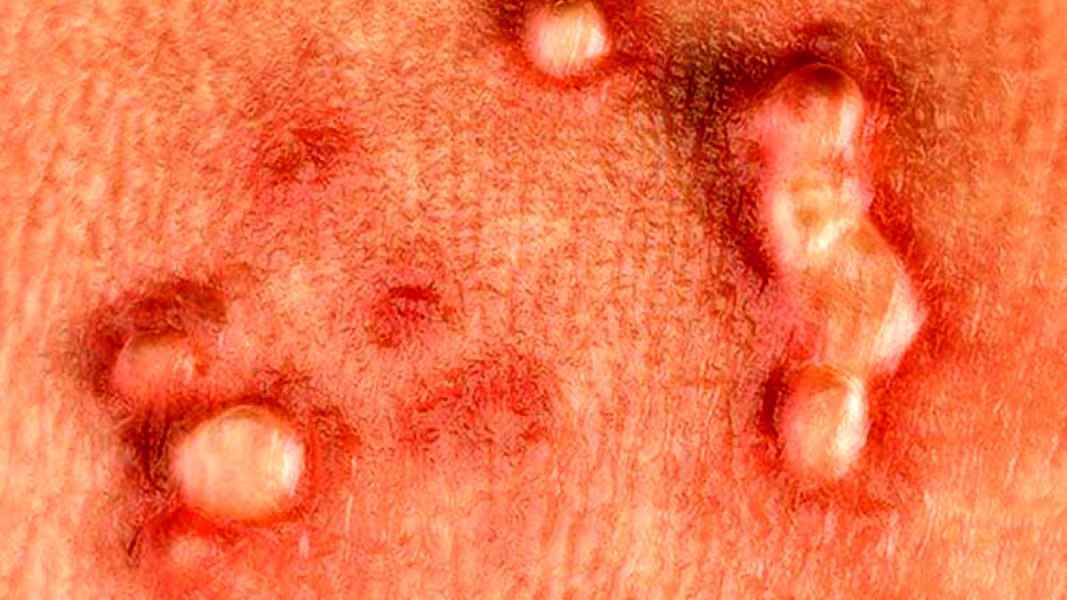 زگیل تناسلی چه علائمی دارد ؟