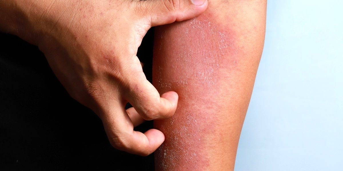 بیماری اگزما چیست و چگونه درمان میشود؟