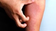 بیماری اگزما چیست و چگونه درمان می‌‌شود؟