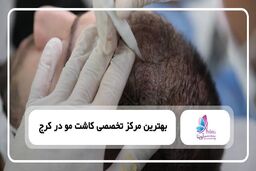 قبل از کاشت مو چه نکاتی را باید رعایت کرد؟ چک لیست آمادگی برای بهترین نتیجه 