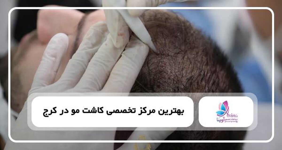 قبل از کاشت مو چه نکاتی را باید رعایت کرد؟ چک لیست آمادگی برای بهترین نتیجه 