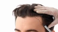 شوک ریزش بعد از کاشت مو: کابوس موقت یا شکست دائمی؟
