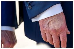 ترامپ بیماری ملکه را گرفته است