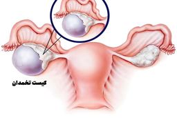 آیا در رحم کیست ایجاد می شود؟