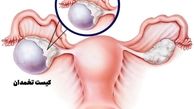 آیا در رحم کیست ایجاد می شود؟