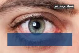 این ۱۱ علت چشم‌درد را حتماً جدی بگیرید