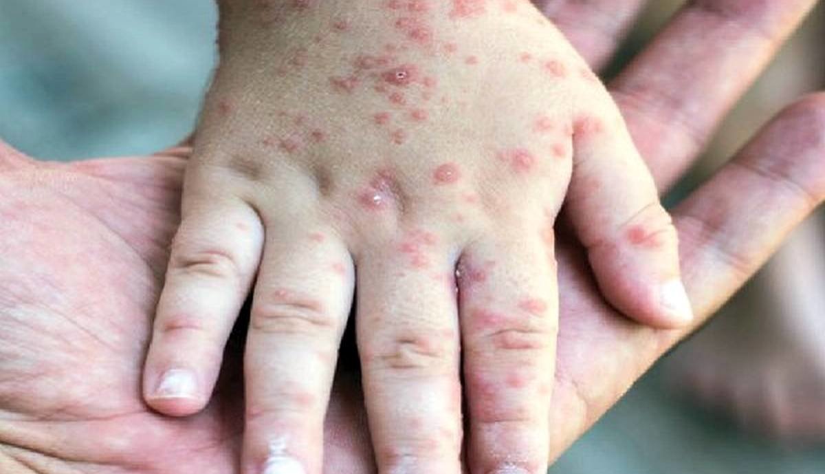 هشدار شدید وزارت بهداشت | تعداد مبتلایان سرخک رو به افزایش است