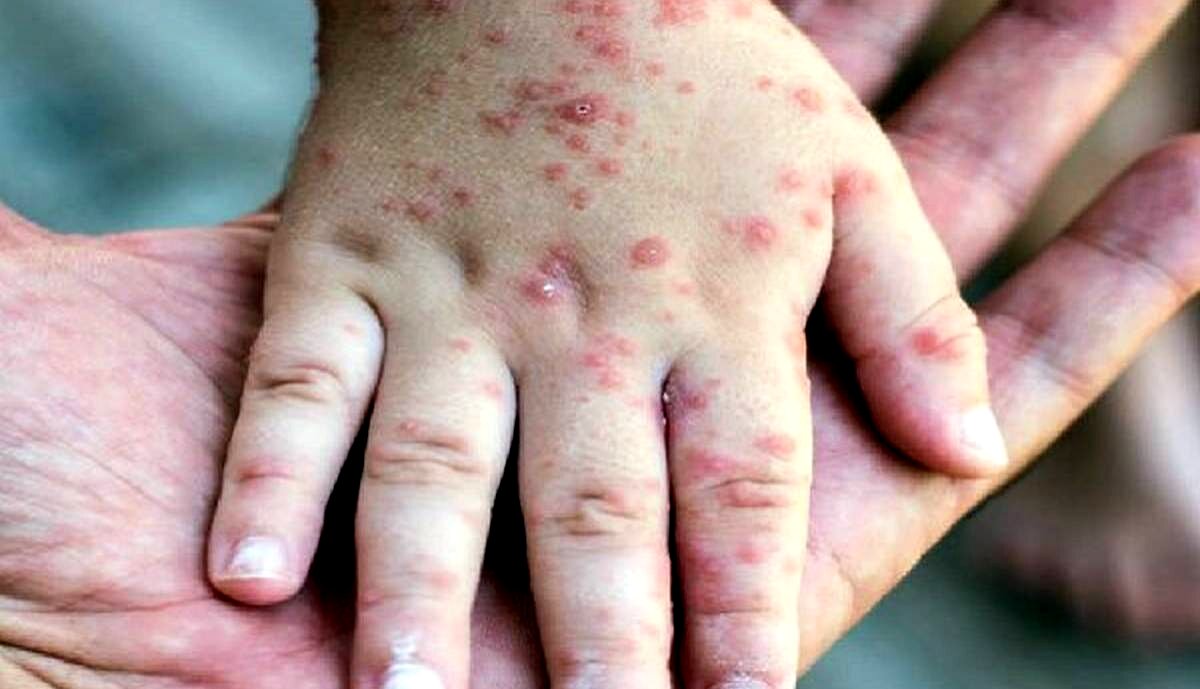 هشدار شدید وزارت بهداشت | تعداد مبتلایان سرخک رو به افزایش است 