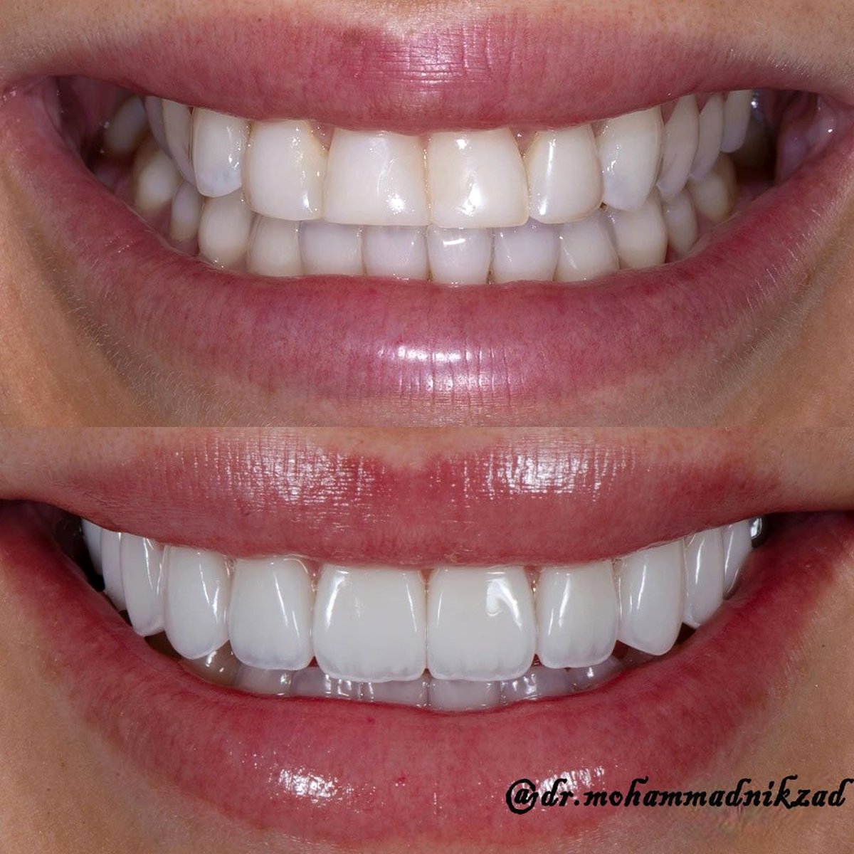 لبخندت را رها کن، لمینت سرامیکی راهی همیشگی برای زیباترین لبخند