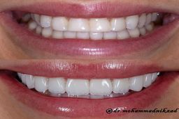 لبخندت را رها کن، لمینت سرامیکی راهی همیشگی برای زیباترین لبخند