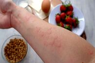 برای درمان کهیر چه بخوریم؟