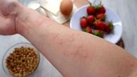 برای درمان کهیر چه بخوریم؟