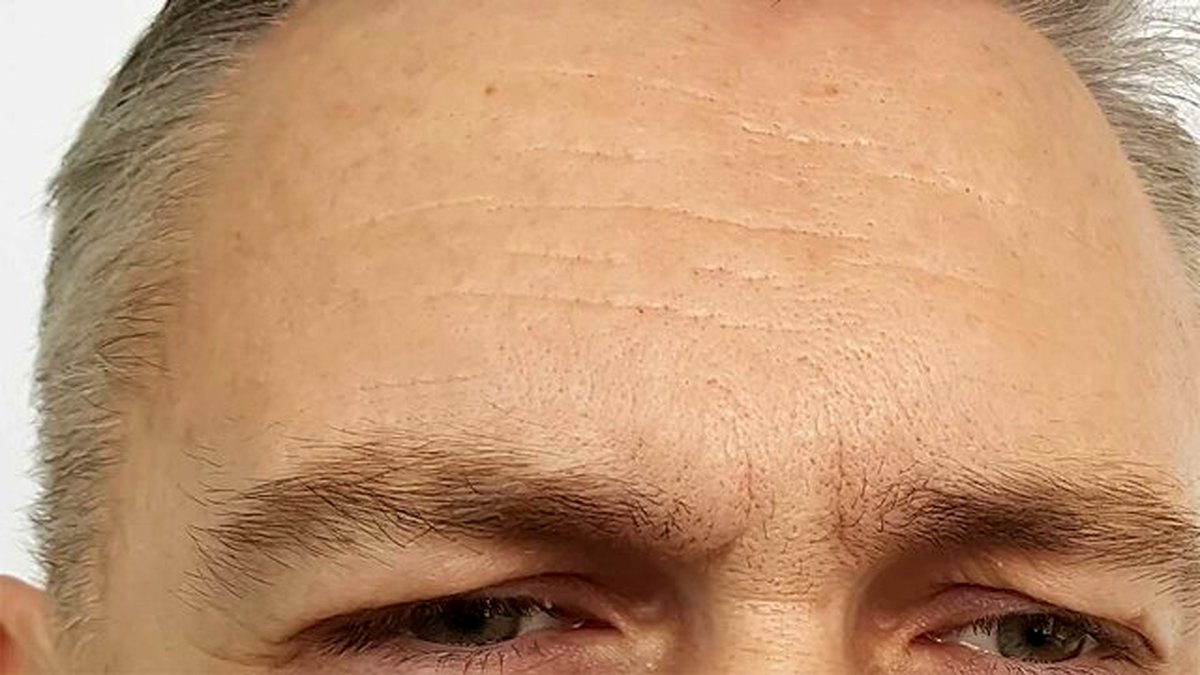 علل و درمان خارش پیشانی