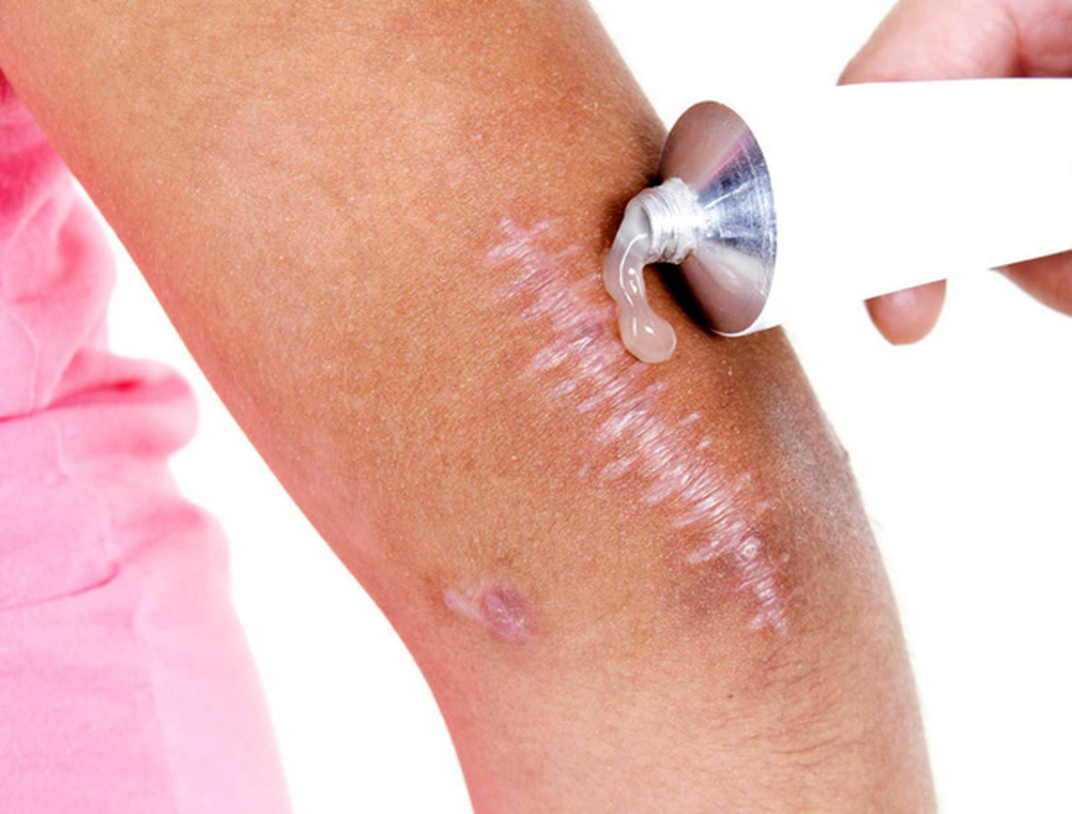 با این روش جای زخم دیگر باقی نمی ماند