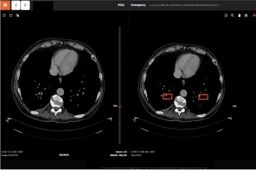 ایران سامانه هوش مصنوعی تشخیص کرونا را رایگان به کشورها می دهد