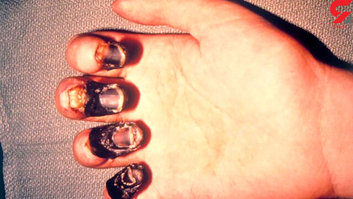 آیا طاعون خیارکی نگران کننده است؟