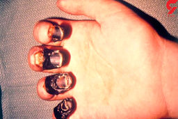 آیا طاعون خیارکی نگران کننده است؟