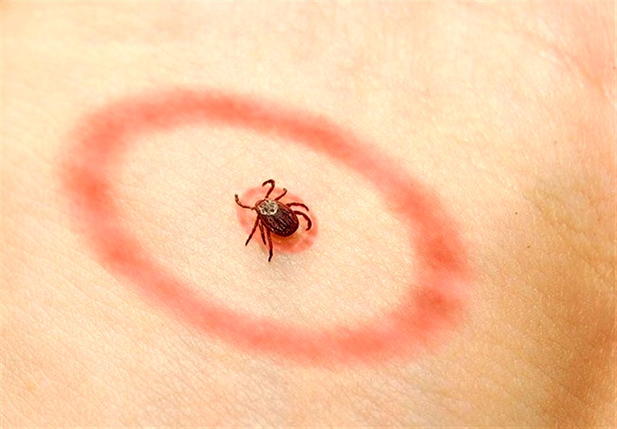 بیماری "لایم" چیست؟