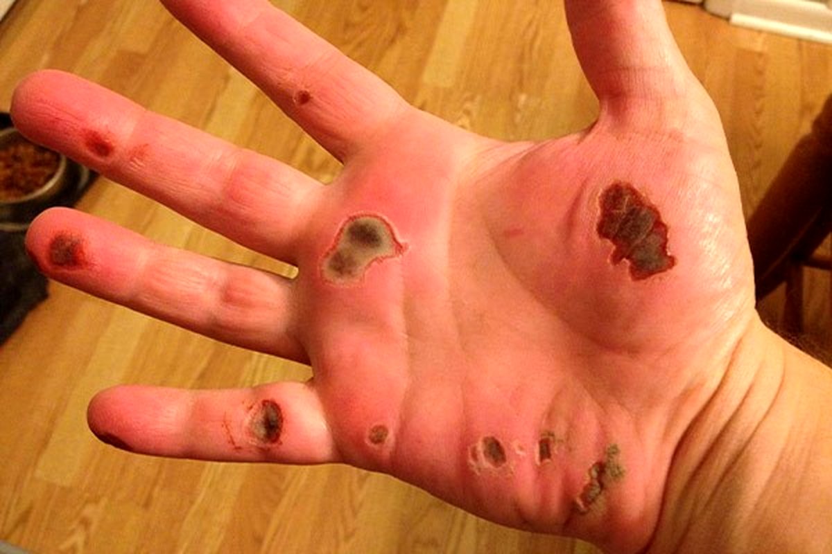 حساسیت و سوختگی دست با سیمان - پیشگیری و درمان