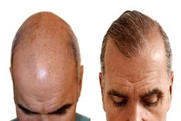 بهترین کلینیک کاشت مو شرق تهران