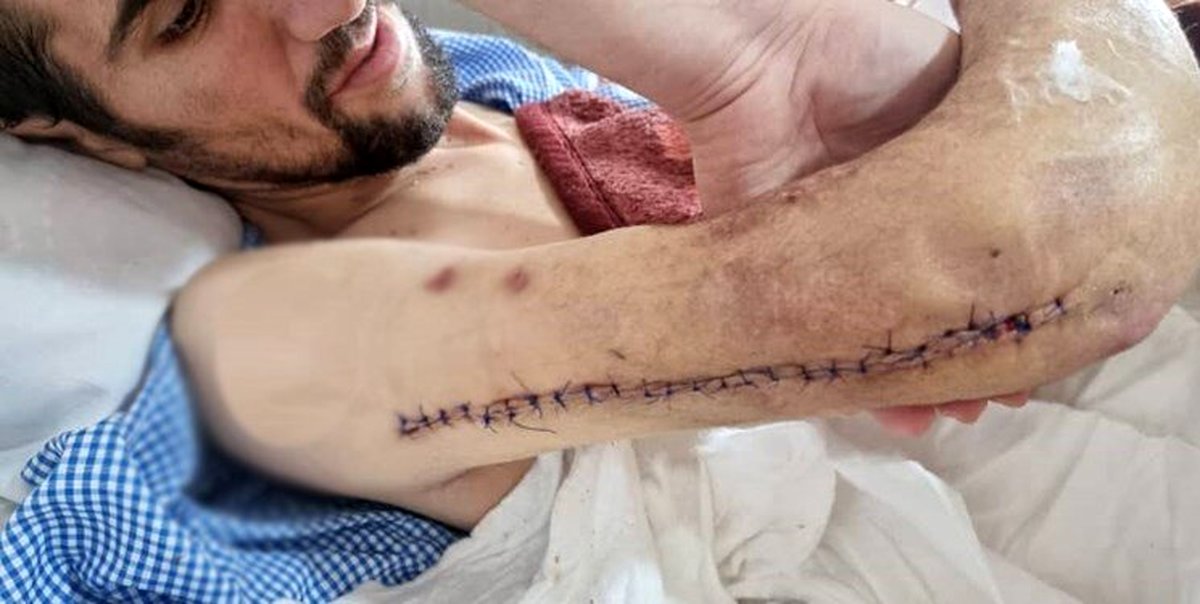 حادثه وحشتناک در یزد | پیوند موفقیتآمیز دست جداشده یک کارگر