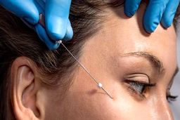 نتایج فوری لیفت نخ؛ بررسی علمی و تخصصی یکی از پرطرفدارترین روش‌های جوان‌سازی