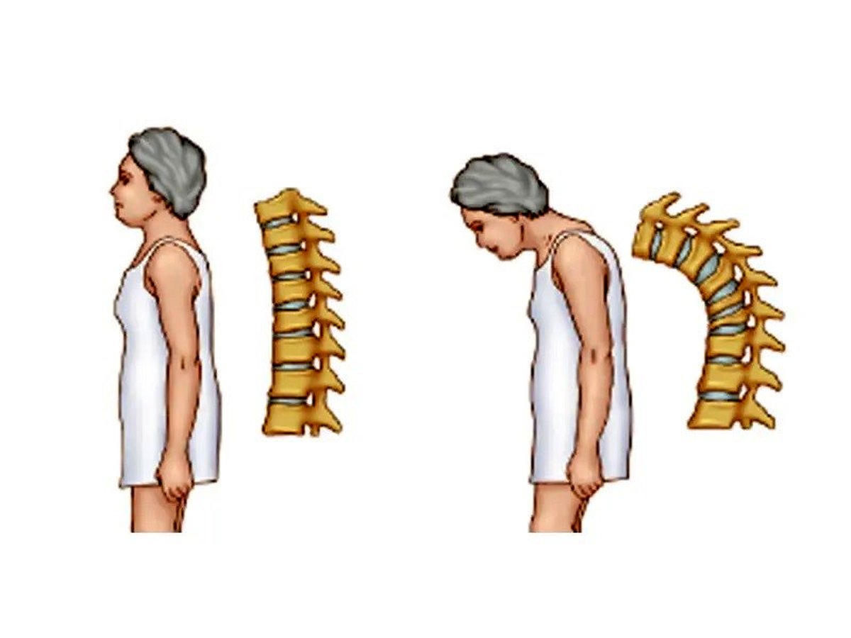 چگونه قوز کمر رو در خانه از بین ببریم؟